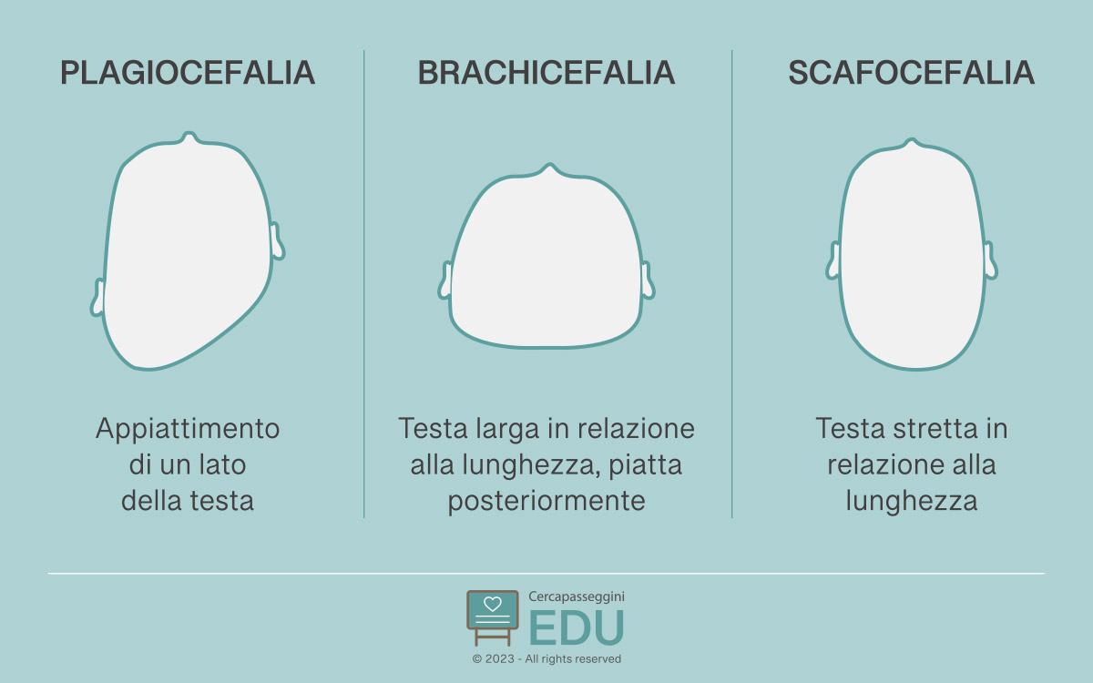 Le tipologie di plagiocefalia